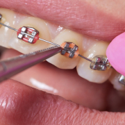 traditional braces